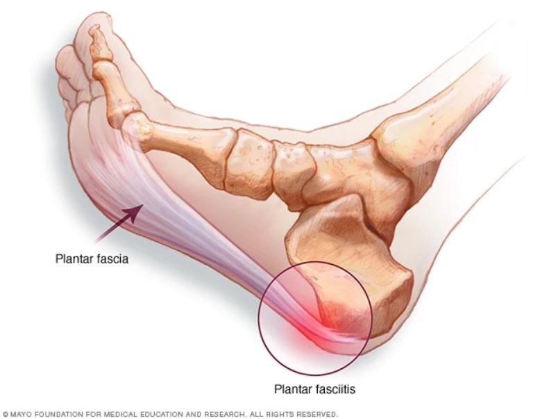 asics and plantar fasciitis